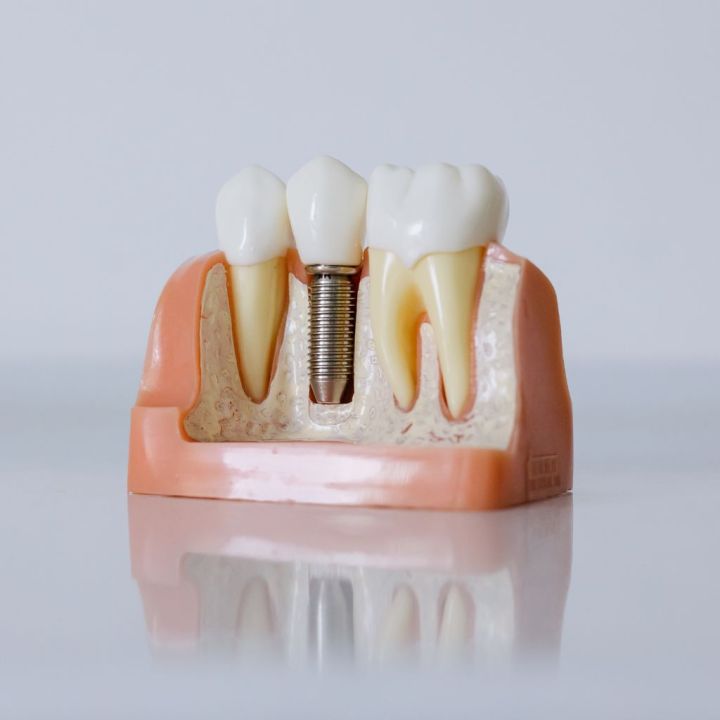 Smaganu iekaisums ap zobu implantu - kāpēc rodas un kad jāvēršas pie zobārsta? 