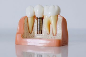 Attēls rakstam: Smaganu iekaisums ap zobu implantu - kāpēc rodas un kad jāvēršas pie zobārsta? 