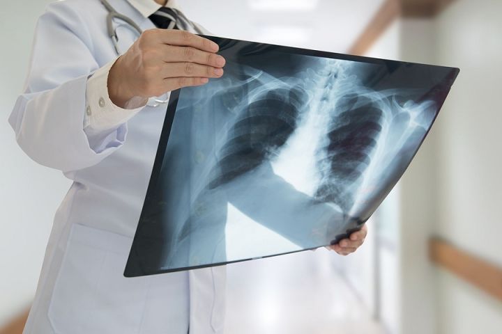Pērn ar tuberkulozi slimojuši vairāk nekā 300 cilvēki