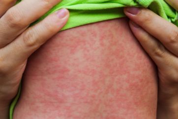 Attēls rakstam: Latvijā reģistrēts pirmais masalu uzliesmojums kopš 2018. gada