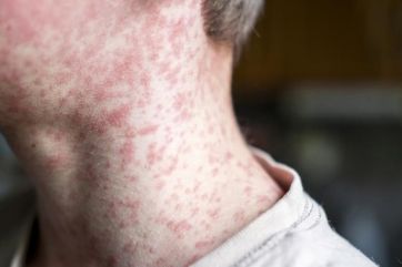 Attēls rakstam: Apstiprināts masalu gadījums: SPKC aicina atsaukties cilvēkus, kas varētu būt bijuši kontaktā ar inficēto